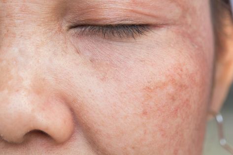 4 Easy Ways To Reduce Sun Damage Now Age Spots On Face, Brown Age Spots, Treating Hyperpigmentation, Skin Care Specialist, Natural Face Mask, Freckle Face, Sun Damaged Skin, Spots On Face, Skin Discoloration