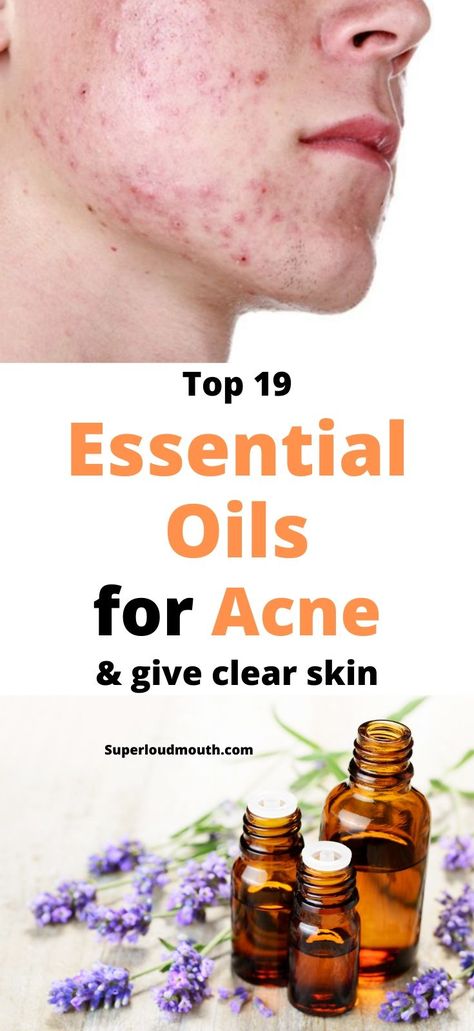 Essential Oils For Acne, Oils For Acne, Face Mapping Acne, Essential Oils For Face, Treating Acne, Diy Acne, Natural Acne Remedies, Natural Acne, Baking Soda Shampoo