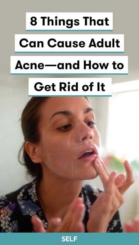 Zit Remedy, Chin Acne, Back Acne Remedies, Forehead Acne, Acne Overnight, Bad Acne, Acne Treatments, How To Get Rid Of Pimples, Acne Causes