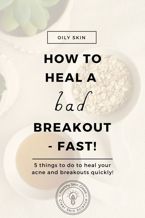 Want to get rid of breakouts quickly? Do these 5 things every time you are having a breakout to heal it super quick! Breakout Remedies, Cystic Acne Treatment, Forehead Acne, Back Acne Treatment, Bad Acne, Natural Acne Remedies, Natural Acne, Acne Breakout, Cystic Acne