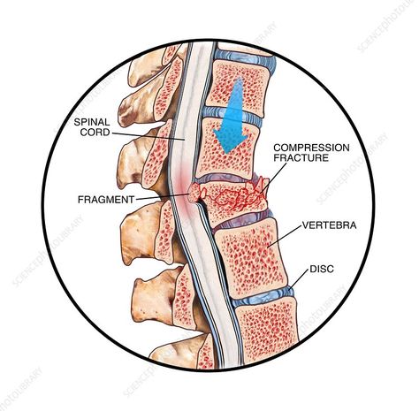 Spinal compression fracture Spinal Cord Anatomy, Human Body Vocabulary, Nerve Anatomy, Knee Exercise, My Knee Hurts, Knee Pain Exercises, Spinal Surgery, Spine Health, Kinesiology Taping