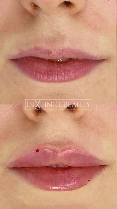 https://pin.it/7ueO5YwJy Pillow Lips Filler, Lip Filler Inspo Heart Shape, Bow Shaped Lip Filler, Keyhole Lip Fillers, Upper Lip Filler, Light Lip Filler, Lip Filler On Small Lips, Russian Lips Filler Before And After, Top Lip Filler