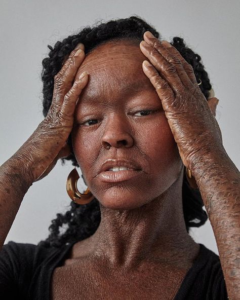 Woman Who Sheds Skin Every Two Weeks Becomes Probably The First Model Who Has This Condition | Bored Panda Black Motivation, Film Characters, Fabulous Women, Real Bodies, Photographie Inspo, Skin Condition, Homemade Face Masks, Beauty Standards, Interesting History