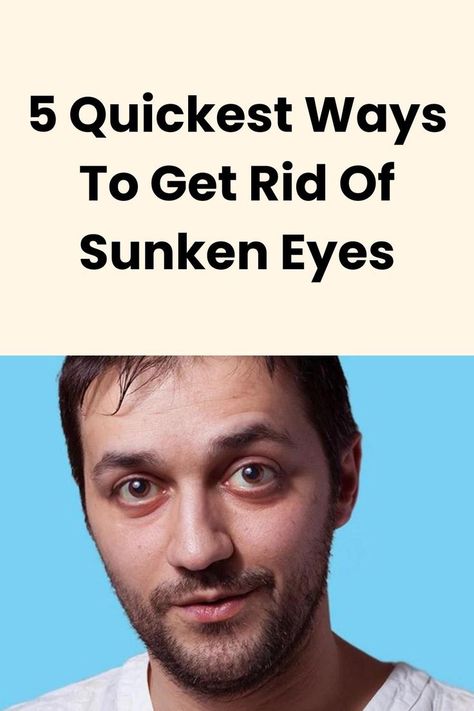 How To Get Rid Of Sunken Eyes, How To Get Rid Of Sunken Under Eyes, Sunken Under Eyes Remedies, Under Eye Hollows Remedies, Puffy Eyes Remedy How To Get Rid, Sunken Eyes Remedy, Sunken In Eyes, Sunken Under Eyes, Baggy Eyes Remedy