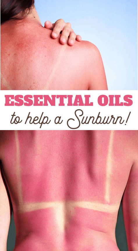 Doterra Sunburn Relief, Sunburn Essential Oils, Oils For Sunburn Relief, Best Sunburn Remedy, Doterra Sunburn, Sunburn Relief Essential Oils, Sun Burn Remedy, Itchy Sunburn, Sunburn On Face