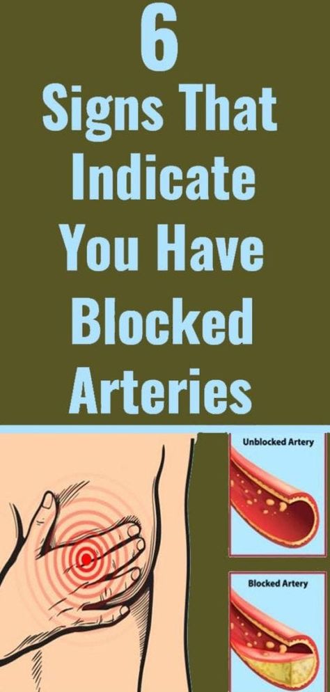 6 Warning Signs of Clogged Arteries Home Medicine, Clogged Arteries, Natural Home Remedies, Warning Signs, Regular Exercise, Healthy Tips, Health And Nutrition, Healthy Habits, Natural Health