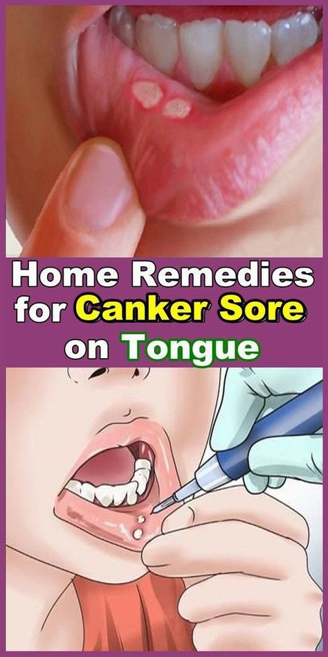 Home Remedies for Canker Sores on Tongue | My-FavThings | Bloglovin’ Sores On Tongue, Canker Sore On Tongue, Canker Sore Causes, Canker Sore Remedy, Tongue Sores, Canker Sore, Oral Care Routine, Receding Gums, Oral Health Care