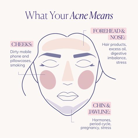 Period Pimples, What Causes Pimples, Face Mapping Acne, Blind Pimple, Pimples Under The Skin, Skin Facts, Prevent Pimples, Skin Advice, Face Mapping