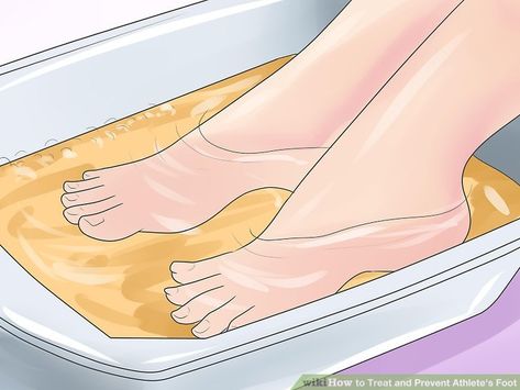 How to Treat and Prevent Athlete's Foot (with Pictures) - wikiHow Athletes Foot, Hand Crochet Baby Blanket, Mermaid Blanket, Foot Pain, Digestion Problems, Small Photos, Stay Fit, Clothes Pins, Pain Relief