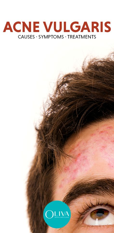 Acne Vulgaris is a type of skin ailment, which causes inflammation and blockage of hair follicles due to oil or dead skin cells. It usually is prone in areas with a dense population of sebaceous follicles. #acnevulgaris #acneremoval #clearpimples #clearskin #pimples Vellus Hair, How To Clear Pimples, Blind Pimple, Pimples Under The Skin, Skin And Hair Clinic, Type Of Skin, Acne Vulgaris, Severe Acne, Hair Clinic