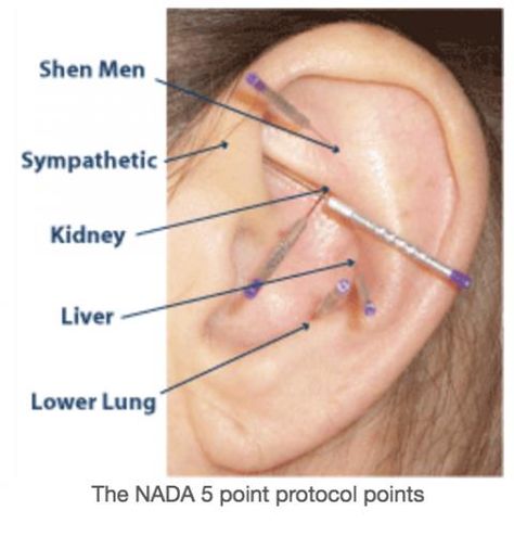 Nada Protocol, Auricular Acupuncture, Ear Acupressure, Ear Reflexology, Ink Link, Acupuncture Benefits, Reflexology Chart, Acupuncture Points, Acupressure Points