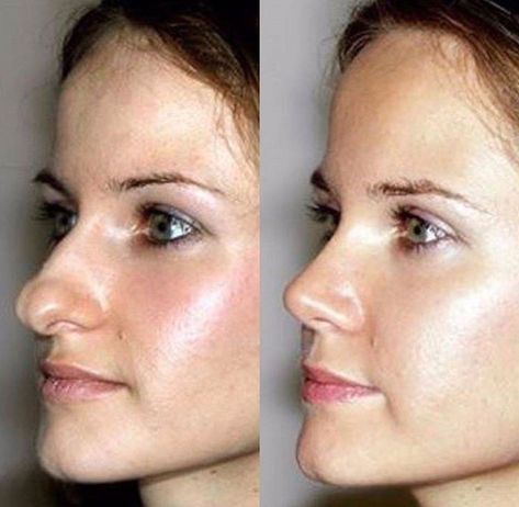 Kpop Plastic Surgery, Jaw Reduction Surgery, Nose Plastic Surgery, Nose Surgery Rhinoplasty, Plastic Surgery Fail, Korean Plastic Surgery, Rhinoplasty Nose Jobs, Botox Before And After, Nose Reshaping