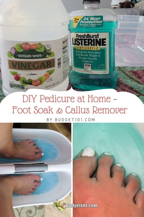 Callus Remover Diy, Homemade Pedicure, Home Foot Soak, Diy Pedicure At Home, Pedicure Soak, Homemade Foot Soaks, Callous Remover, Listerine Foot Soak, Diy Foot Soak