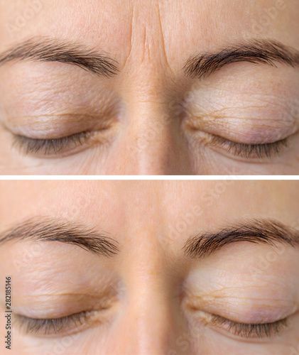 Stock Image: Woman's face skin before and after aesthetic beauty cosmetic procedures with removed skin wrinkles Lines On Forehead, Frown Lines, Lifting Facial, Skin Line, Face Wrinkles, Wrinkled Skin, Cosmetic Procedures, Deep Wrinkles, Yves Rocher