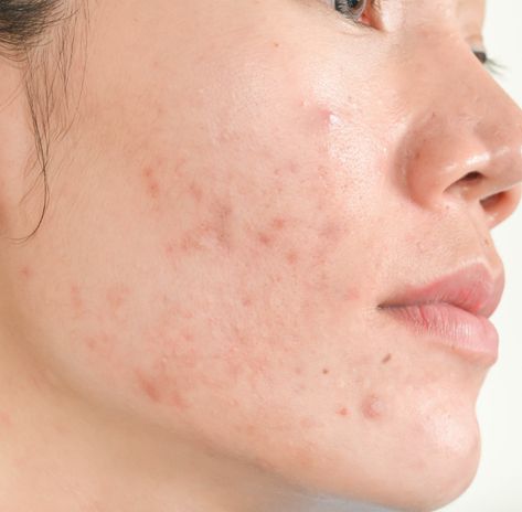 Die Off Symptoms, Demodex Mites, Treating Cystic Acne, Facial Scars, Treating Hyperpigmentation, Post Inflammatory Hyperpigmentation, Acne Vulgaris, Acne Breakout, Face Acne