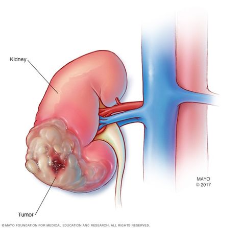 Kidney Tumor, Renal Cell Carcinoma, Cell Forms, Healthy Kidneys, Organ Transplant, Kidney Health, Medical Tourism, Mayo Clinic, Surgery