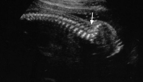 Lumbar lordosis Ob Ultrasound, Gyn Ultrasound, Obstetric Ultrasound, Lumbar Lordosis, Medical Ultrasound, Radiology Imaging, Baby Ultrasound, Spina Bifida, Second Trimester