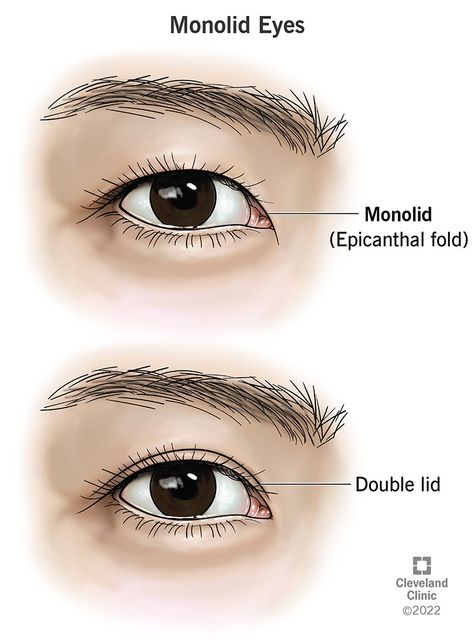 Monolid Eyes: Epicanthal Folds & Causes Epicanthic Fold, Monolid Eyes, How To Use Makeup, Droopy Eyelids, Fetal Alcohol, Excess Skin, Upper Eyelid, Double Eyelid, Eye Surgery