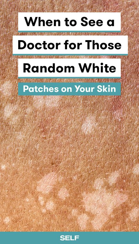 White Skin Patches, White Skin Spots, Pigmentation Remedy, Dark Patches On Skin, How To Become Healthy, Become Healthy, Dry Skin Patches, Skin Spots, White Patches