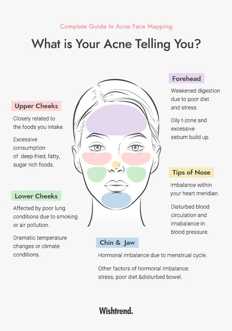 What Different Areas Of Acne Mean, Reasons Why You Have Acne, What Does Acne On Your Forehead Mean, Placement Of Pimples Meaning, What Does Ur Acne Mean, What My Acne Is Telling Me, Why Acne Is Where It Is, Where Ur Acne Is Meaning, What Is Causing My Acne