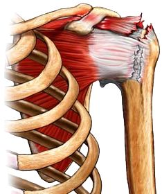 Torn Rotator Cuff Symptoms, Rotator Cuff Rehab, Shoulder Muscle Pain, Rotator Cuff Pain, Rotator Cuff Exercises, Rotator Cuff Surgery, K Tape, Shoulder Dislocation, Shoulder Rehab