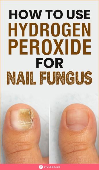 Symptoms of nail fungus vary in severity and may include: Nail discoloration (white, yellow, or brown). Nail thickening. Nail cracking. Nail fragility. Nail distortion. Nail pain (in severe cases). Slight foul odor. Fungal skin infection of the foot, commonly between the toes (may accompany a fungal toenail infection). While fungal nail infections can infect fingernails and toenails, toenails are more commonly affected. |Feet nails |feet pictures |feet pics |feet care Penny Ball, Toenail Health, Nail Remedies, Peroxide Uses, Toenail Fungus Remedies, Nail Infection, Nail Fungus Remedy, Holistic Diet, Nail Fungus Treatment