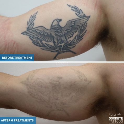 Tattoo Transformation: Progress 🦅 Check out this incredible progress after just 6 laser tattoo removal treatments! Our client, with a 10-year-old black ink eagle tattoo, is already seeing amazing results. 💪✨ Our client is healthy which contributes to the success of the removal process. Remember, a healthy lifestyle can enhance your tattoo removal journey! Ready to say goodbye to your unwanted ink? Dial 1300 74 50 74 today and start your journey to clear skin. 🌟 #tattooremoval #lasertatt... Tattoo Transformation, Eagle Tattoo, Laser Tattoo, Laser Tattoo Removal, Tattoo Removal, To Say Goodbye, A Healthy Lifestyle, Clear Skin, Healthy Lifestyle