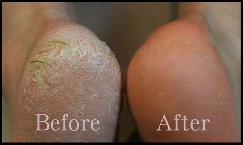 If you've got tons of dry, scaly skin on the bottoms of your feet, try a Baby Foot exfoliating mask. Dry Cracked Heels, Scaly Skin, Exfoliating Mask, Foot Soak, Cracked Heels, Callus Removal, Skin Problems, Dead Skin, العناية بالبشرة