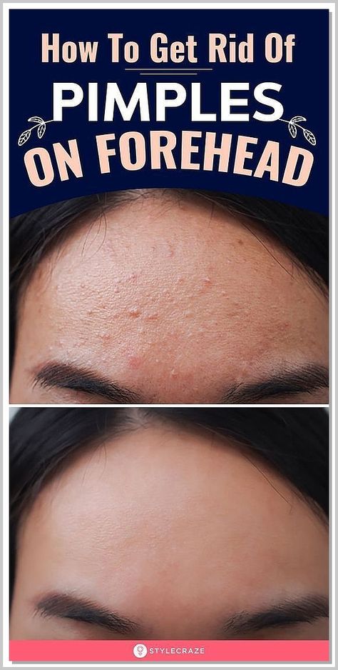 Achieve a youthful and radiant eye area with Amazon's best selling eye care products. Forehead Acne Cause, Get Rid Of Forehead Acne, Pimples On Forehead, Forehead Acne, Get Rid Of Pimples, Rid Of Pimples, Pimples Remedies, Clear Skin Face, Skin Face Mask