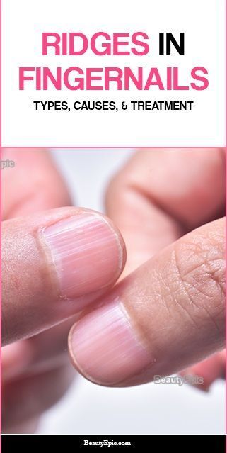 Fingernail Ridges, Fingernail Health, Natural Hair Removal Remedies, Nail Remedies, Nail Ridges, Nail Problems, Nail Fungus Remedy, Tongue Health, Lines On Nails