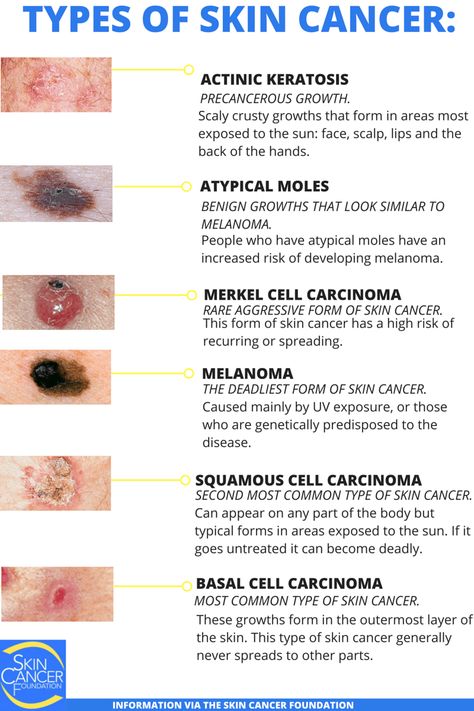 Dermatology Nurse, Wound Care Nursing, Blood Disorders, Basal Cell, Skin Moles, Squamous Cell, Nursing School Survival, Types Of Skin, Nursing School Tips