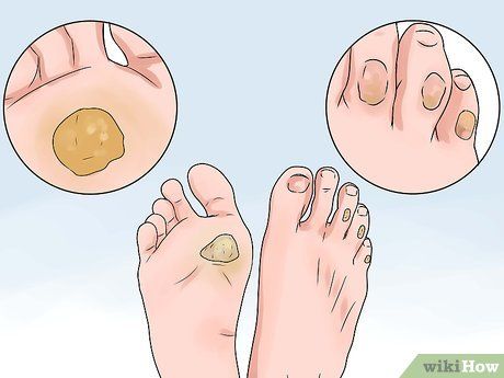 How to Treat a Corn or Callus (with Pictures) - wikiHow Callus Remover Diy, Get Rid Of Corns, Corn Removal, How To Make Corn, Nail Problems, Corn Seed, Cracked Heels, Callus Removal, Detox Your Body