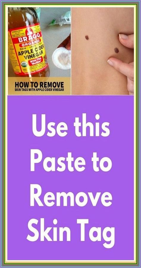 How to Remove Skin Tag in 1 Night Apple Cider Vinegar Uses, Remove Skin Tags Naturally, Remove Skin Tags, Unfiltered Apple Cider Vinegar, Vinegar Uses, Organic Apple Cider, Skin Tags, Organic Apple Cider Vinegar, Healthy Advice