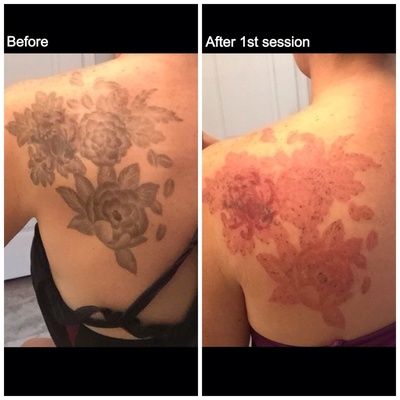 Back Tattoo Removal using the PicoSure Laser. Tattoo Removal Before And After, Picosure Tattoo Removal, Small Heart Tattoo, Small Heart Tattoos, I Am So Tired, Body Condition, Laser Tattoo, Laser Tattoo Removal, So Tired