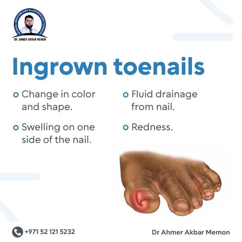 Ingrown Toenail, Ingrown Nail, Homemade Laundry, Ingrown Toe Nail, Excessive Sweating, Homemade Remedies, Skin Care Remedies, Wound Healing, Life Tips