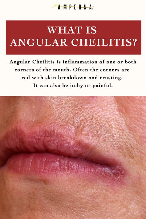 Angular cheilitis is the inflammation of one or both corners of the mouth. Just like PD is can be itchy and dry but shouldn’t be confused with PD which doesn’t tend to affect the lips. Dryness Around Mouth, Angular Cheilitis Remedy Natural, Cracks In Corner Of Mouth, Cracked Lip Corners, Dry Skin Around Mouth, Rash Around Mouth, Lip Infection, Cracked Corners Of Mouth, Angular Cheilitis