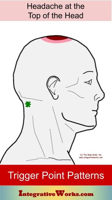 Understanding Trigger Points – Headache on the Top of Your Head | Integrative Works Forward Head Posture Exercises, Forward Head Posture, Summer Health, Head Pain, Doctor Advice, Health And Fitness Magazine, Healthy Diet Tips, Daily Health Tips, Trigger Points