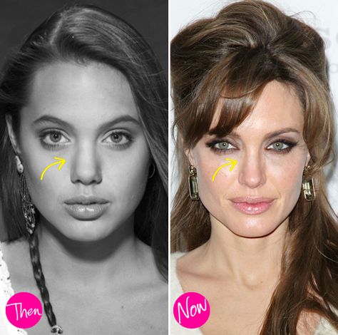 Angelina Jolie before her rhinoplasty. Such a subtle change that made her look even more fabulous!! Angelina Jolie Nose Job, Angelina Jolie Nose, Angelina Jolie Plastic Surgery, Rhinoplasty Nose Jobs, Plastic Surgery Photos, Celebrity Plastic Surgery, Acne Scar Removal, Olivia Culpo, 얼짱 소녀