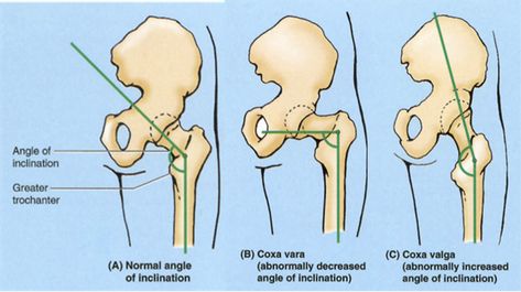 Hip angles and functional variances Hip Anatomy, Yoga Anatomy, Yoga Help, Yoga Therapy, Fitness Experts, Yoga Postures, Yoga Tips, Human Anatomy, Best Yoga