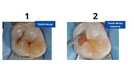 Learn all about back tooth cavity filling, including types of fillings, the procedure, how long they can last, and how to properly care for them. Prevent filling failure with our expert tips and advice. Cavity Filling, Tooth Cavity, Tooth Filling, Tooth Care, Tooth Decay, Tips And Advice, Cavities