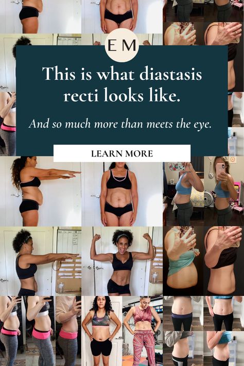 Diastis Recti Exercises, Diastasis Recti Repair, What Is Diastasis Recti, Muscle Separation, Healing Diastasis Recti, Diastasis Recti Exercises, Postpartum Health, Stomach Muscles, Remove Belly Fat