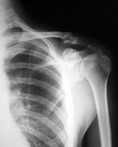 Left Shoulder Xray - Fx Clavicle Shoulder Xray, Injury Aesthetic, Medical Artwork, Broken Ribs, Bone Fracture, Xray Tech, Broken Arm, Shoulder Injuries, Knee Exercises