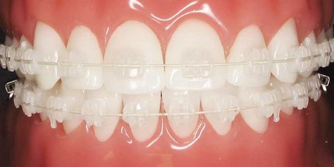 Clarity ADVANCED ceramic brackets Porcelain Braces, Ceramic Braces With Colored Bands, Clear Braces Ceramics, Lightforce Braces, Teeth Makeover, Ceramic Braces, Braces Memes Humor, Advanced Ceramics, Tooth Gem