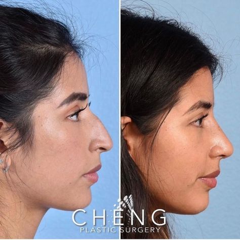 Our lovely patient came to us bothered by her dorsal bump and nostrils. After meticulous planning with Dr. Jackie - they devised a surgical plan that left her with this beautiful result only one month out! ⁣⁣

#rhinoplasty #nosejob #nose #before #after #beforeandafter #transformation #plasticsurgery #plasticsurgeon #surgery #botox #bayarea #chengplasticsurgery Rhinoplasty Recovery Timeline, Botox Nose, Jaw Reduction Surgery, Nose Fillers, Nose Tip, Forehead Lift, Plastic Surgery Fail, Korean Plastic Surgery, Rhinoplasty Nose Jobs