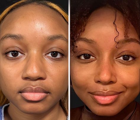 The Cosmetic Lane on X: "Rhinoplasty 👃🏾✨ The idea of an ethnic rhinoplasty is to preserve as much ethnicity as possible while attempting to address concerns patients have with their noses. https://t.co/eeaVvzxVz8" / X Bulbous Nose Rhinoplasty Before After, Wide Nose Rhinoplasty, Ethnic Nose Job, Korean Rhinoplasty, Bad Nose Jobs, Nose Rhinoplasty, Jaw Reduction Surgery, Surgery Aesthetic, Ethnic Rhinoplasty