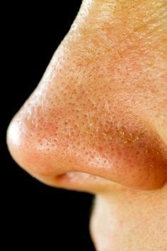 Solutions For Large Pores - What Causes Pores to Enlarge? To Remove Blackheads, Remove Blackheads, Large Pores, Beauty Remedies, Homemade Face, Beauty Recipe, Homemade Beauty Products, Blackhead Remover, Skin Tips