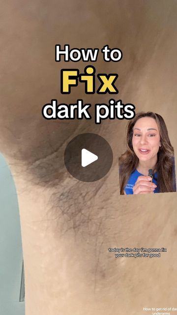 Lindsey Zubritsky, MD, FAAD on Instagram: "How to fix your dark pits: part ✌️ 

Step 1) address the underlying cause
Step 2) fix the darkness

Caution: several of these products mentioned including exfoliating acids (AHAs and BHAs) so use with caution. Start with a lower % and use only a few times a week. Increase as tolerated and decrease if irritation occurs.

As always, it’s best to see a dermatologist for guidance if you have a rash or OTC products don’t work

What’s worked to lighten your dark underarms? Lemme know in the comments below ⬇️" Underarm Darkness Products, Brighten Underarms, Lightening Underarms, Lighten Underarms, Regular Skin Care Routine, Dark Armpits, Skin Lightener, Serious Skin Care, Dark Underarms