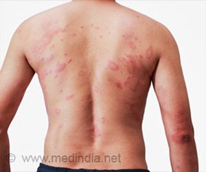 Top 10 Home Remedies to Get Rid of Skin Allergies Shingles Remedies, Allergy Rash, Home Remedies For Allergies, Home Remedies For Warts, Home Remedies For Skin, Allergy Remedies, Skin Allergies, Natural Therapy, Skin Diseases