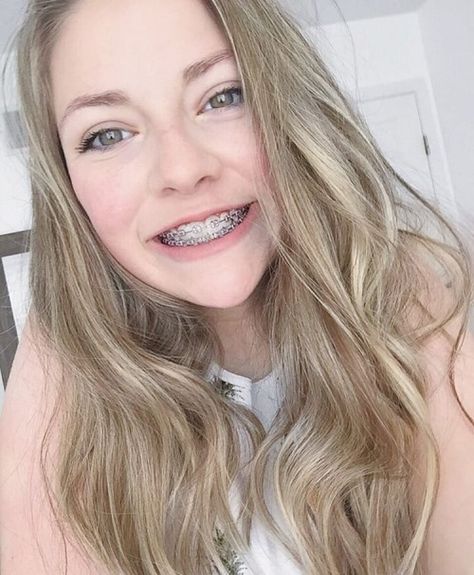 Madison's Girls with Braces-2 Girls With Braces, Lingual Braces, Braces Girls, Cute Braces, Brace Face, Braces Colors, Dental Braces, Perfect Teeth