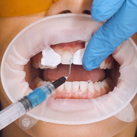 Maison Dental on Instagram: “SWIPE - Composite Bonding In Real Time 🎬🤩” Composite Bonding, Dental Composite, Dental Posts, Real Time, Composition, Nails, On Instagram, Pins, Instagram